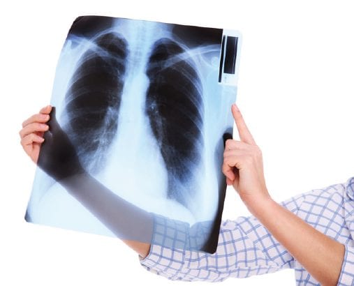 What exactly is an ILO chest x-ray?